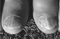 A fungal infection of the toenail.