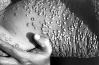 This person, photographed in Bangladesh, has smallpox lesions on skin of his midsection.