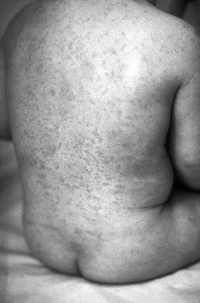 Rash of rubella on the skin of a child's back. Distribution of the rash is similar to that of measles, but the lesions are less intensely red.