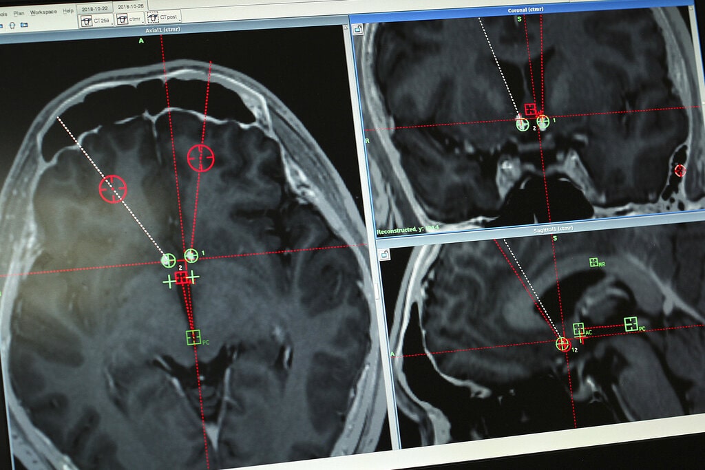 Brain Electrode Implants
